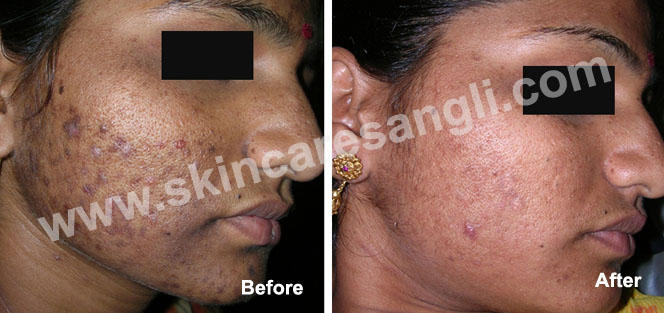 Laser Hair Removal
