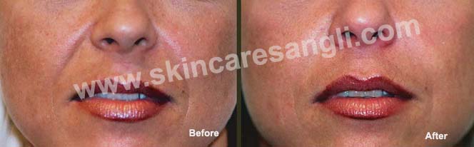 Wrinkle Reduction Results
