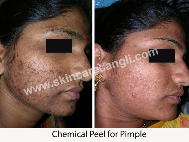Chemical Peeling for Dark Spots