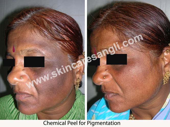 Pigmentation Treatment