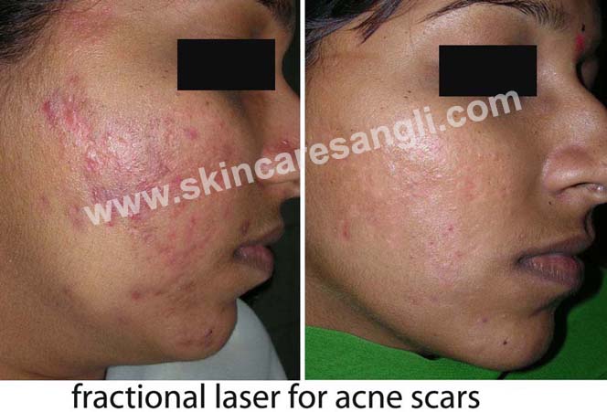 Scar Therapy