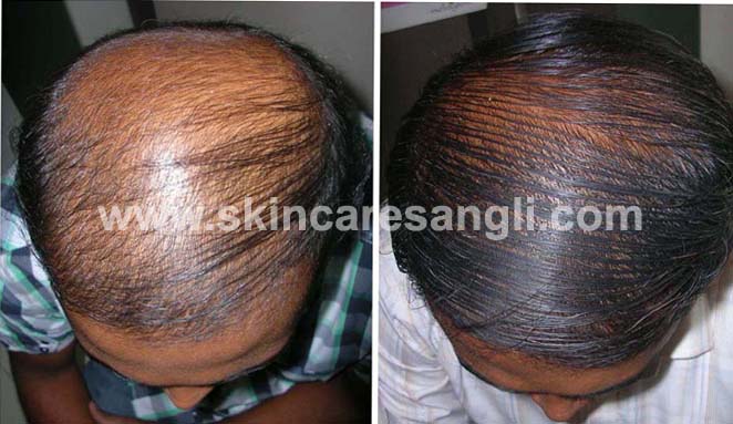 Hair Loss Treatment