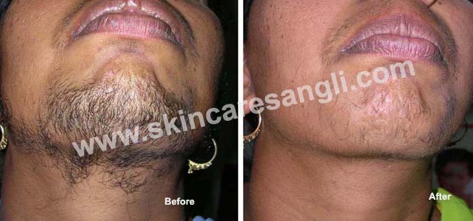 Laser Hair Removal Procedure