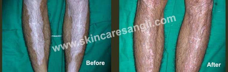 Leukoderma Treatment