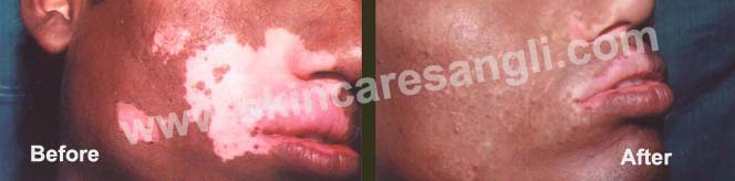 Vitiligo & Leukoderma Repigmentation Result Before After