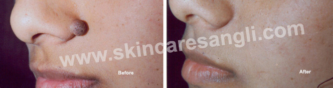 Mole Removal