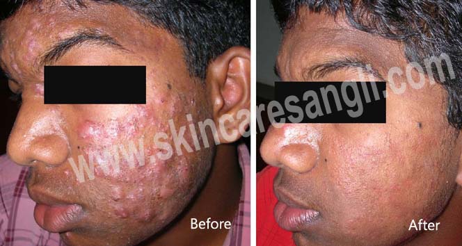 Pimple Treatment