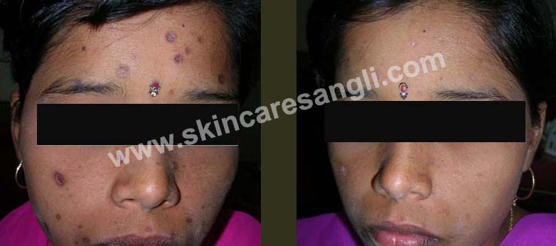 Scar Reduction Result