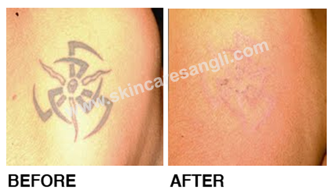 Tattoo Removal
